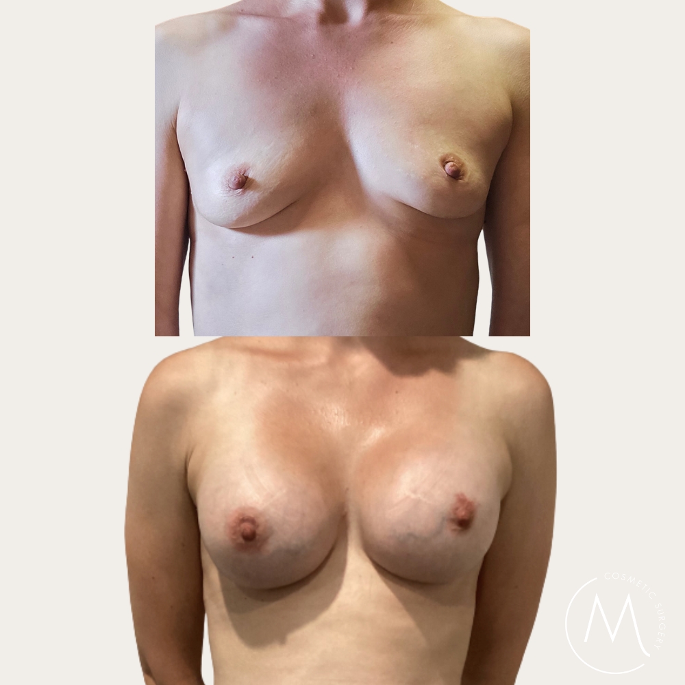 Before and after picture of breast augmentation patient