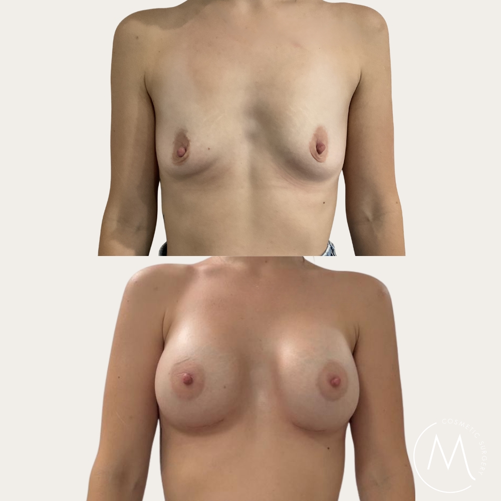 Before and after picture of breast augmentation patient