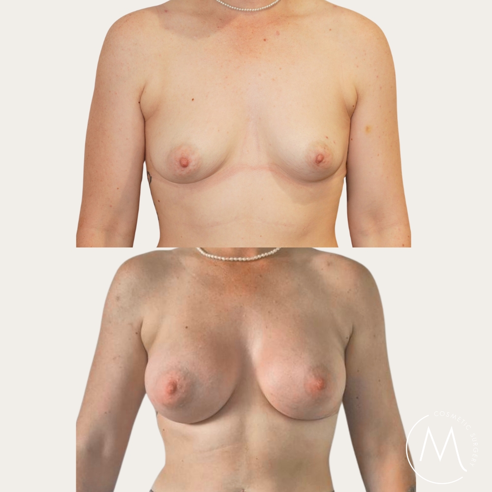 Before and after picture of breast augmentation patient