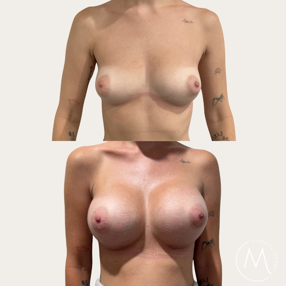 Before and after picture of breast augmentation patient