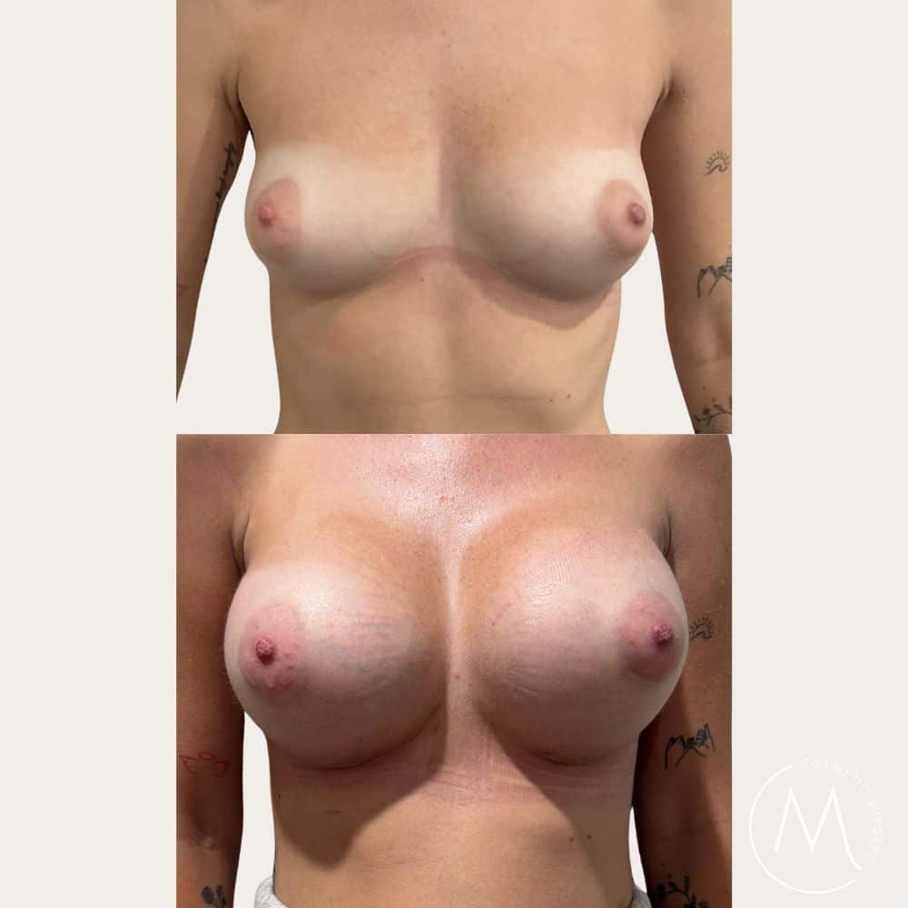 Before and after picture of breast augmentation patient