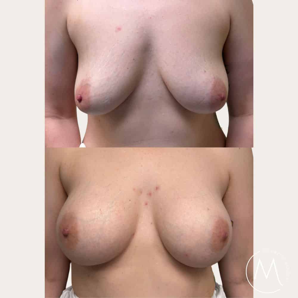 Breast augmentation Melbourne before and after results - MINKST patient
