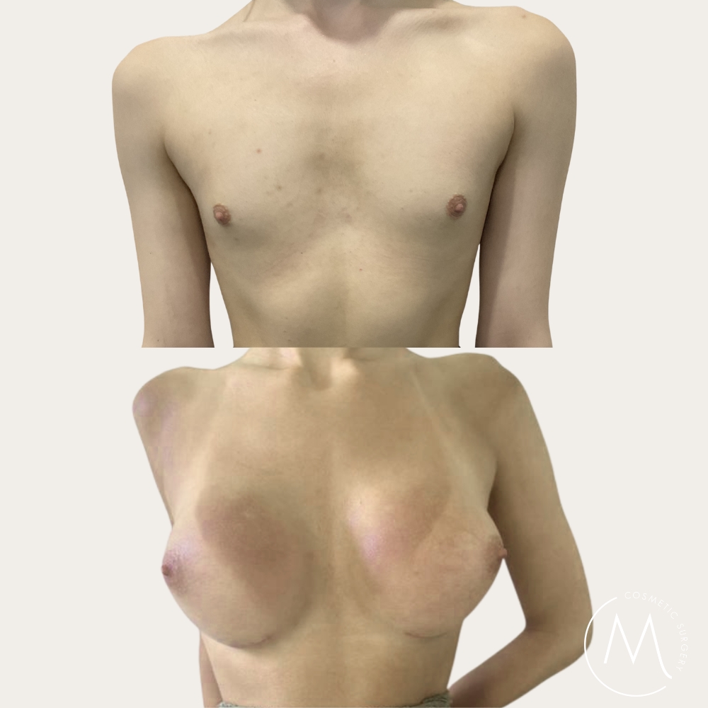 Before and after picture of breast augmentation patient