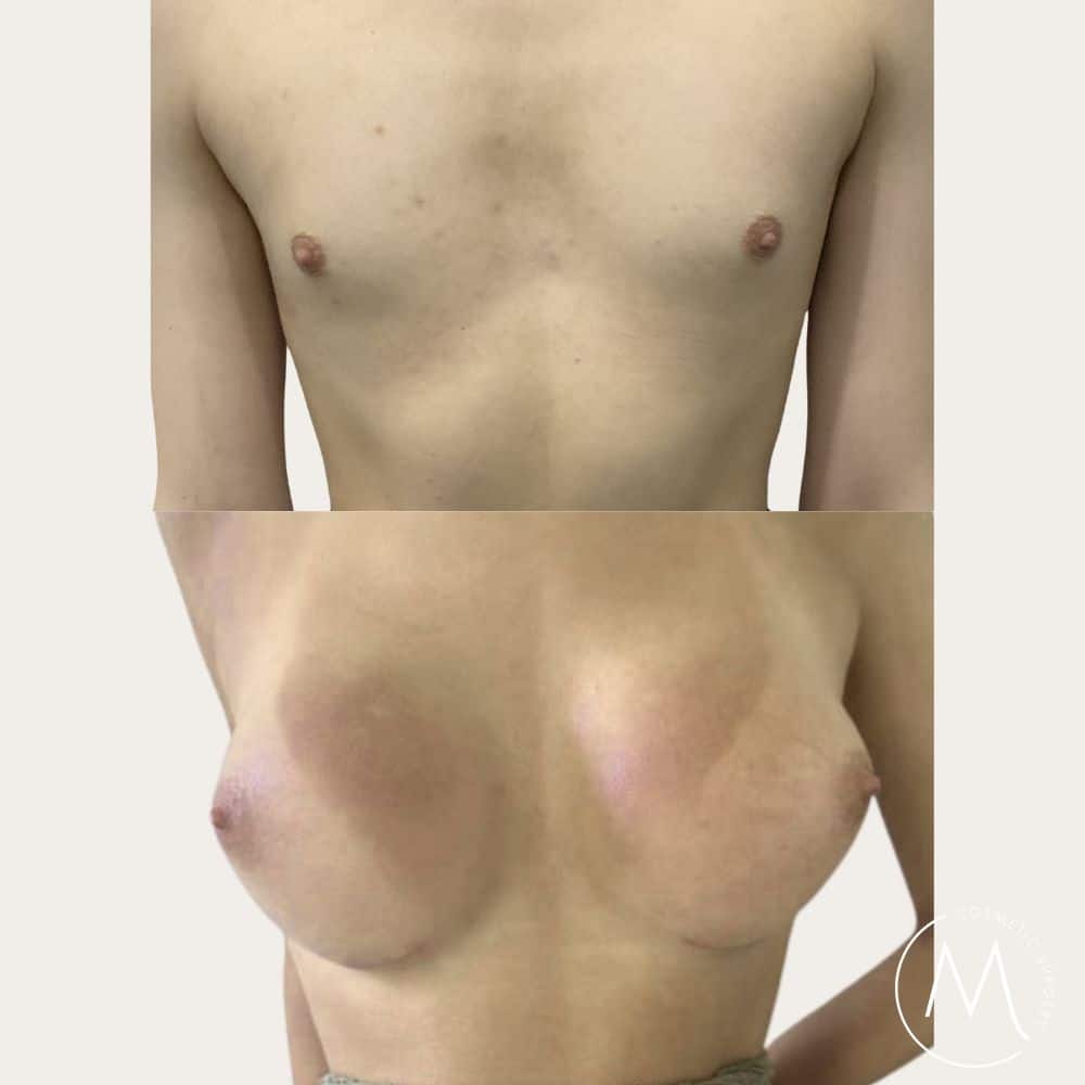 Before and after picture of breast augmentation patient