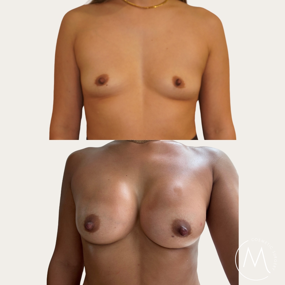 Before and after picture of breast augmentation patient