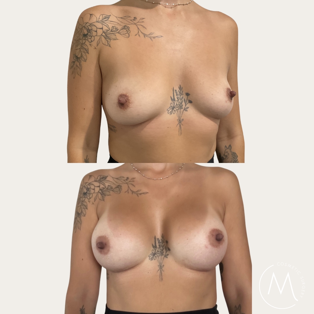 Before and after picture of breast augmentation patient