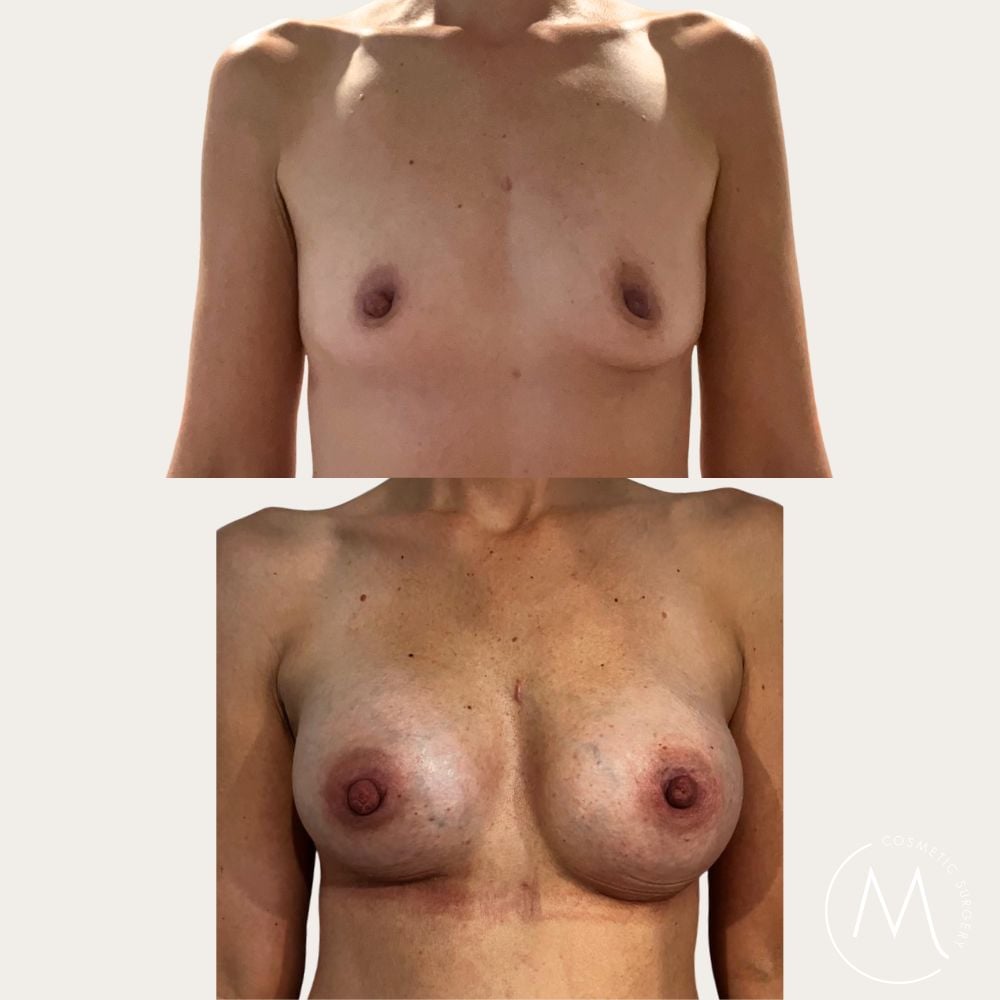 Before and after picture of breast augmentation patient