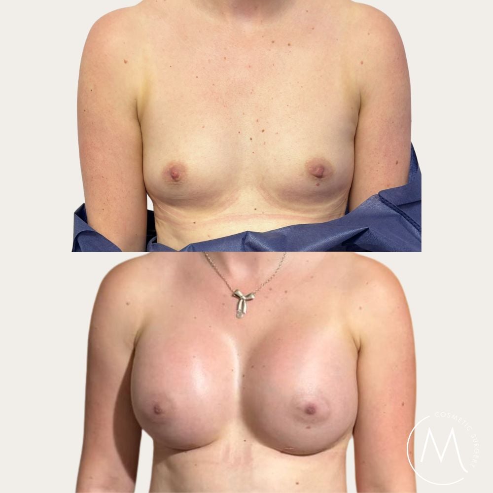 Before and after picture of breast augmentation patient