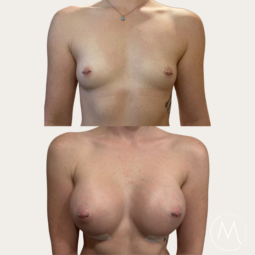 Before and after picture of breast augmentation patient