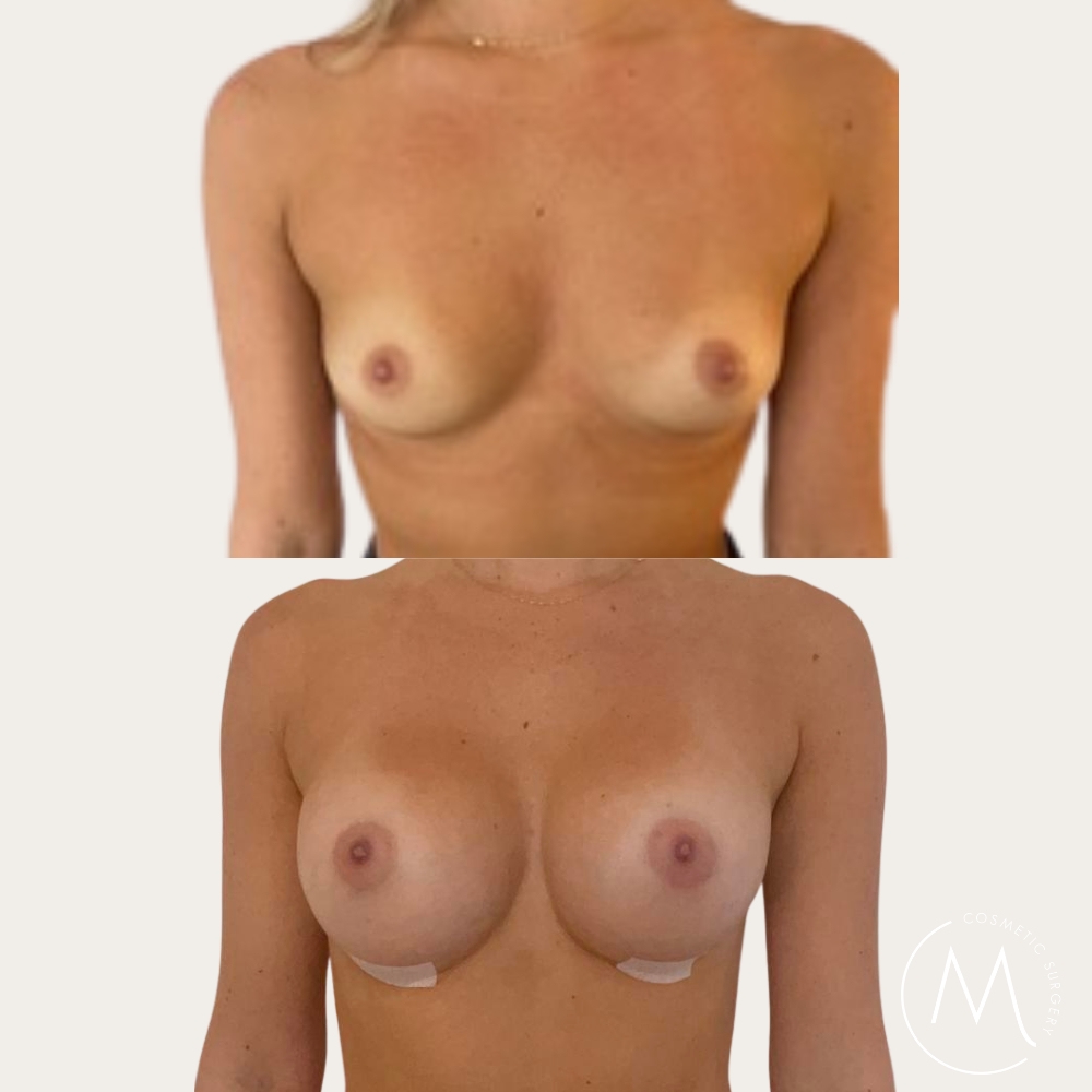 Before and after picture of breast augmentation patient