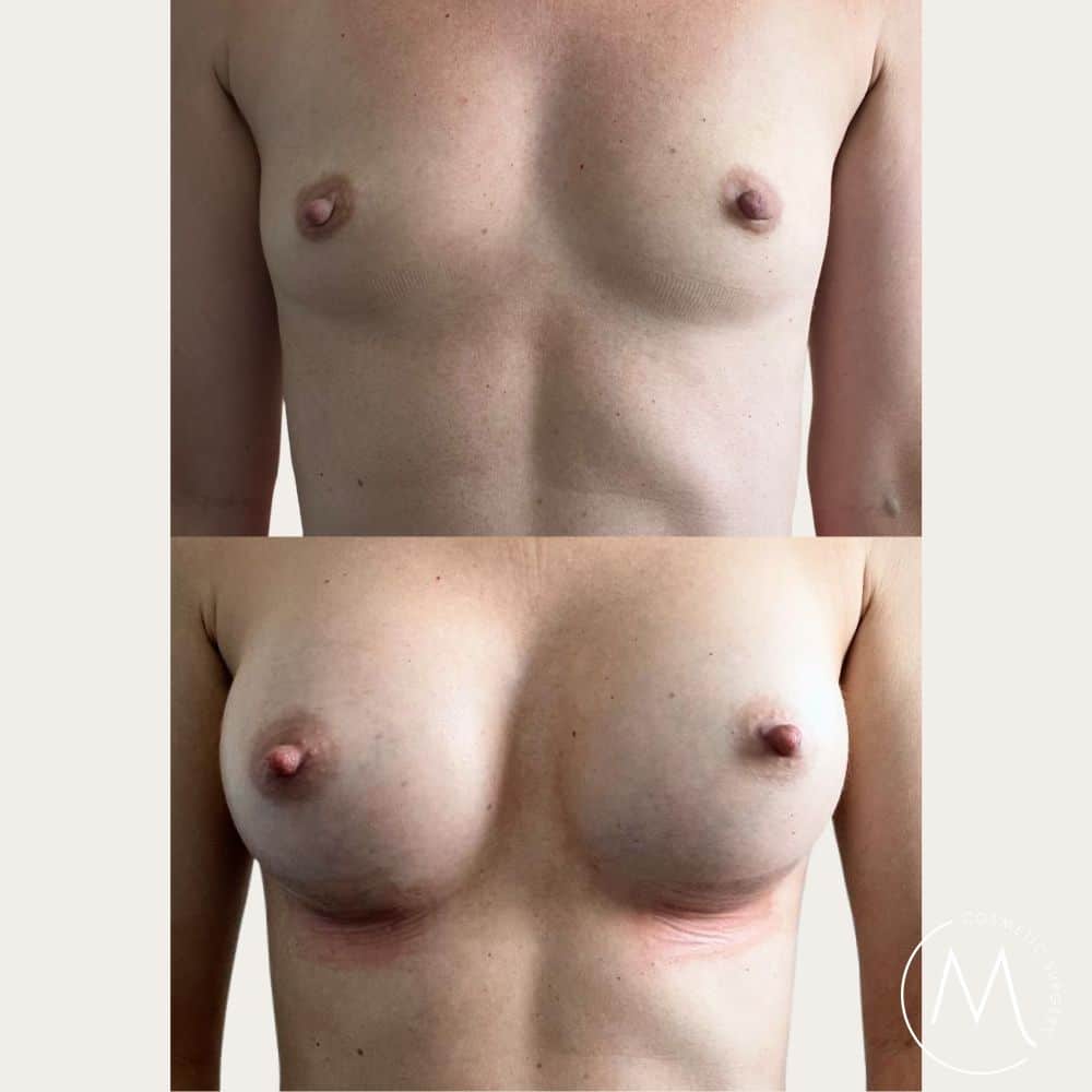 Before and after picture of breast augmentation patient from the Gold Coast