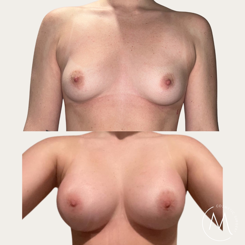 Before and after picture of breast augmentation patient