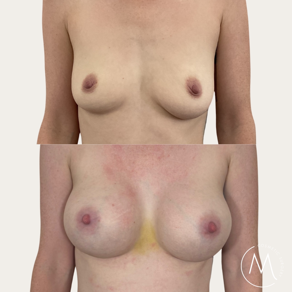 Before and after picture of breast augmentation patient