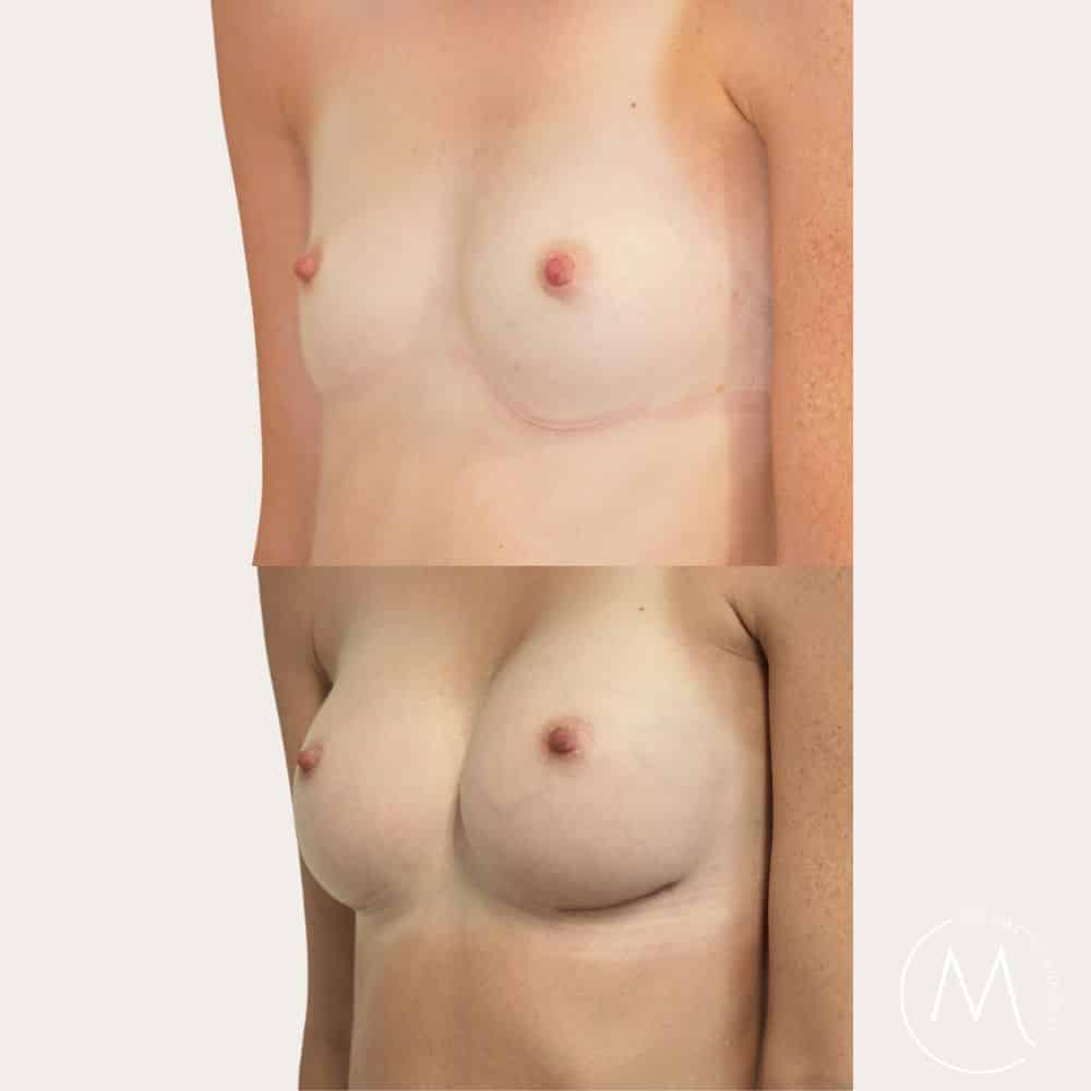 Before and after picture of breast augmentation patient in Adelaide