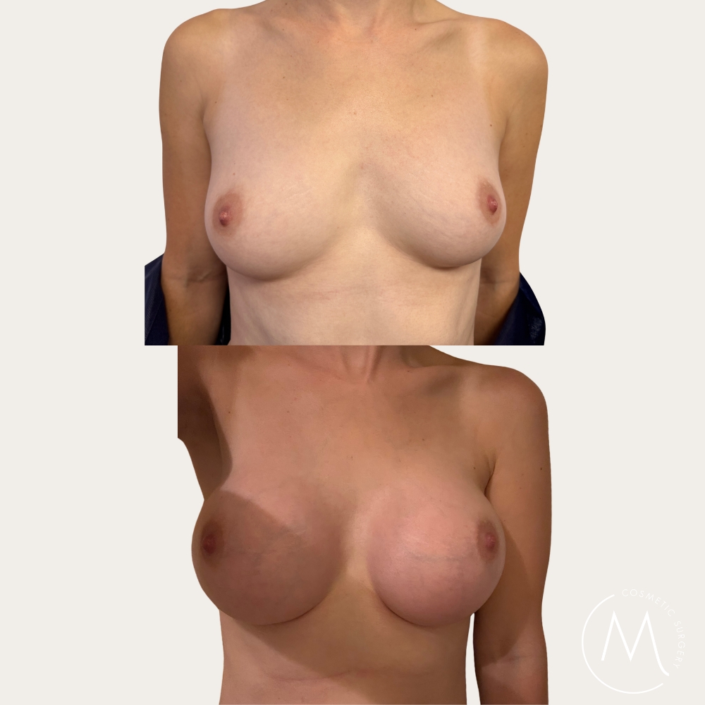 Before and after picture of breast augmentation patient