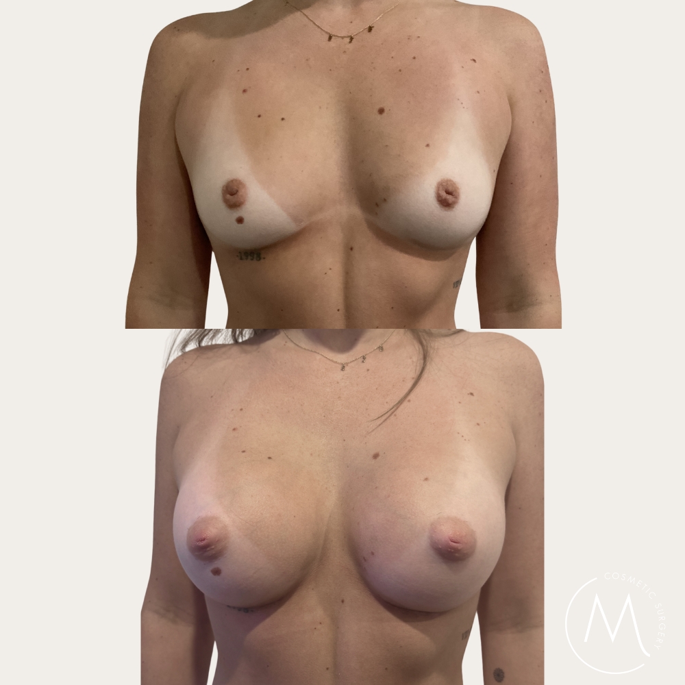 Before and after picture of breast augmentation patient