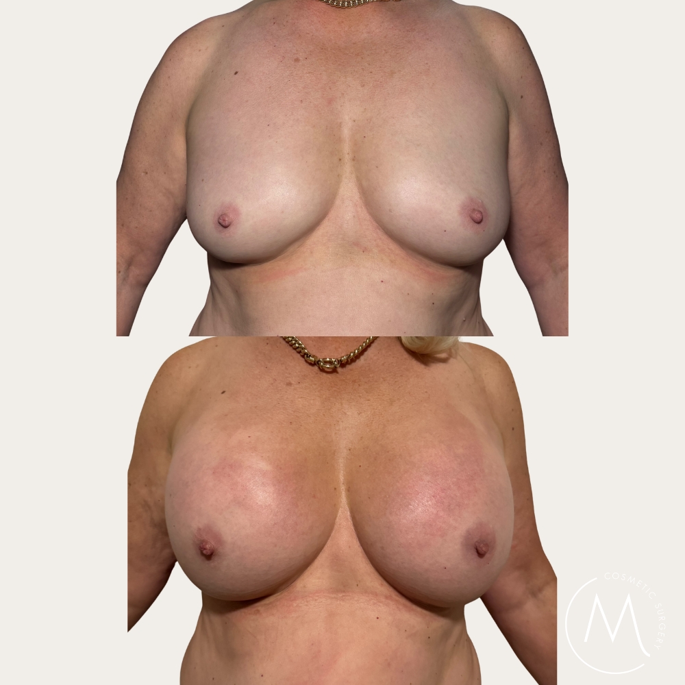 Before and after picture of breast augmentation patient