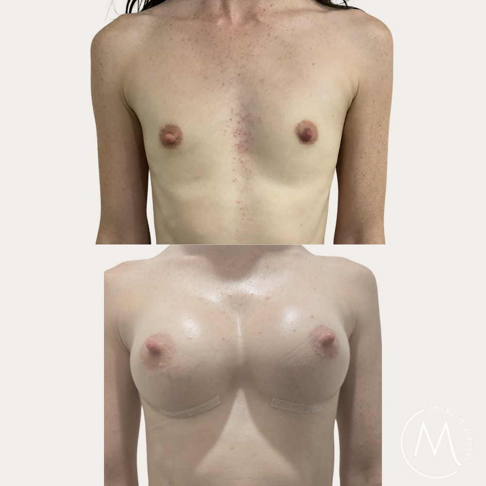 Before and after picture of breast augmentation patient