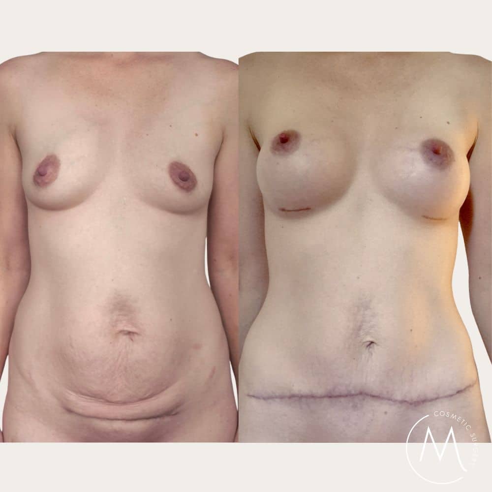 Before and after picture of Breast Augmentation + Tummy Tuck patient
