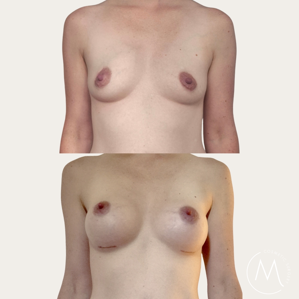 Before and after picture of breast augmentation patient