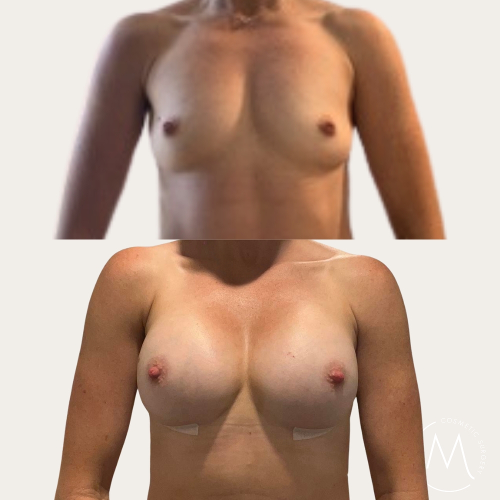 Before and after picture of breast augmentation patient