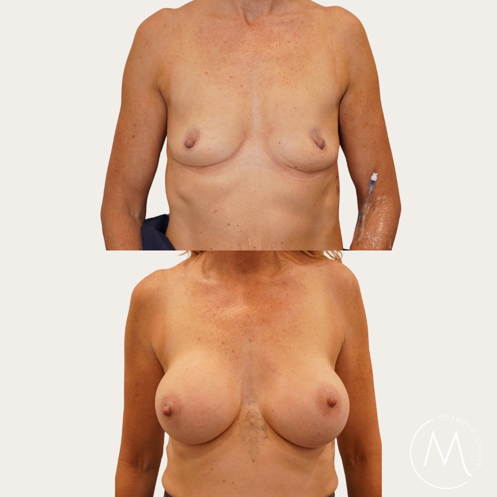 Before and after picture of breast augmentation patient