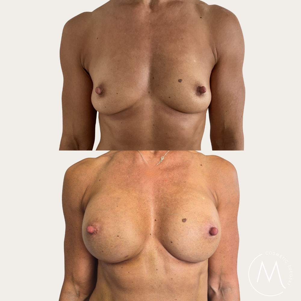Before and after picture of breast augmentation patient
