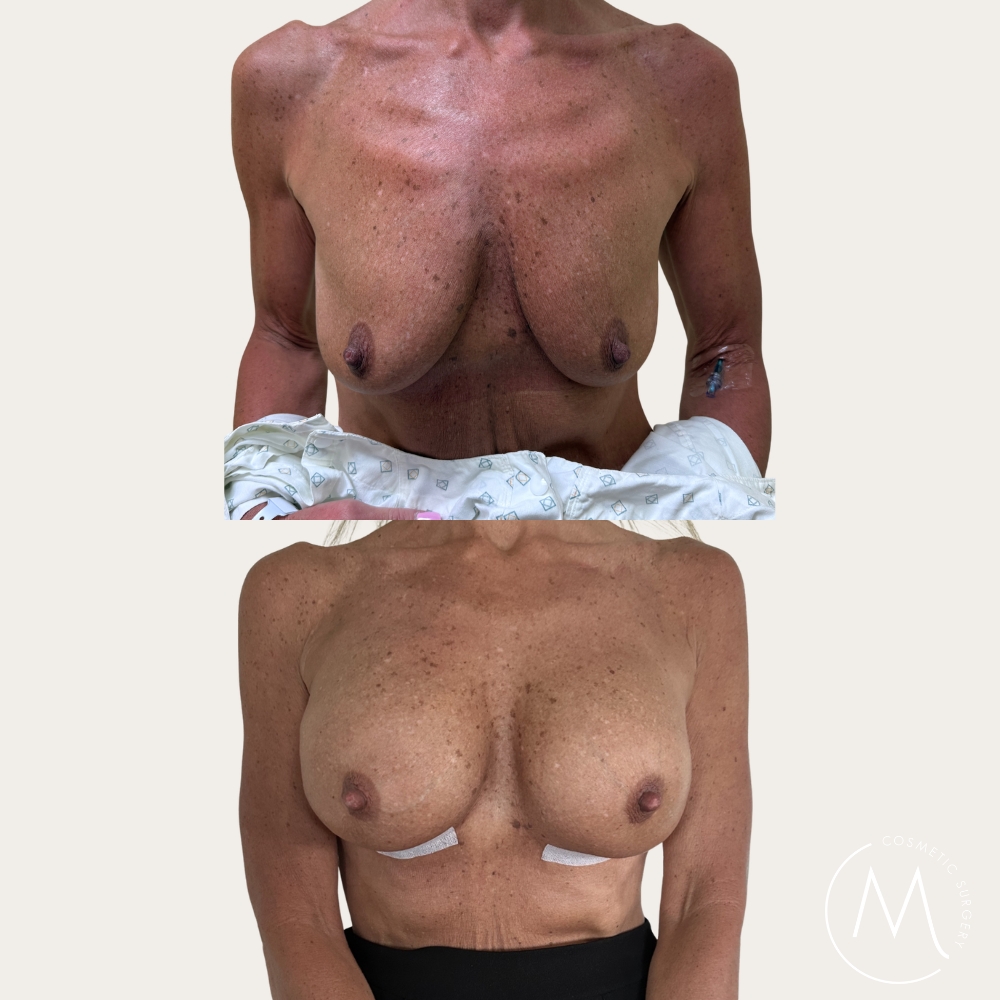Before and after picture of breast augmentation patient