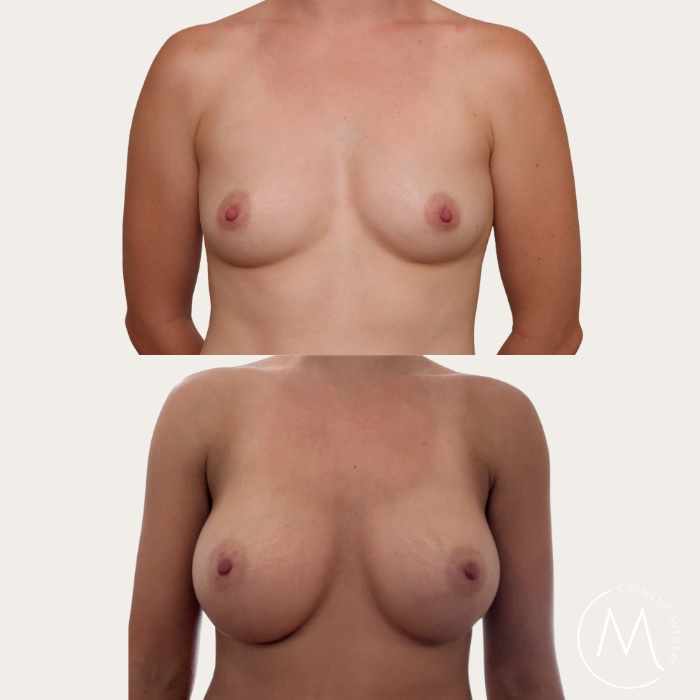 Before and after picture of breast augmentation patient