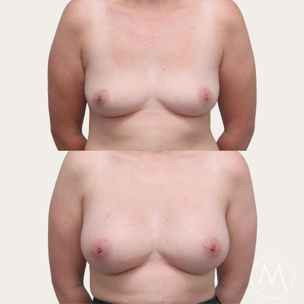 Before and after picture of breast augmentation patient