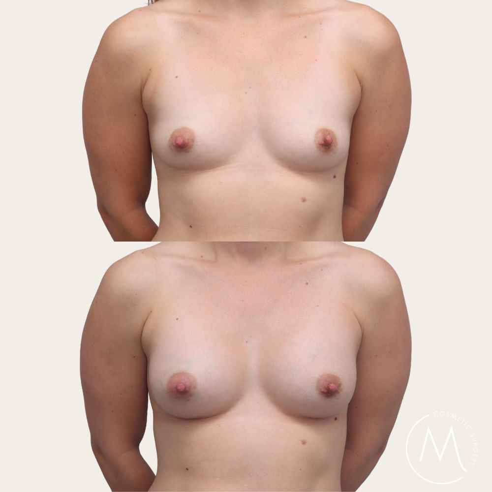 Before and after picture of breast augmentation patient