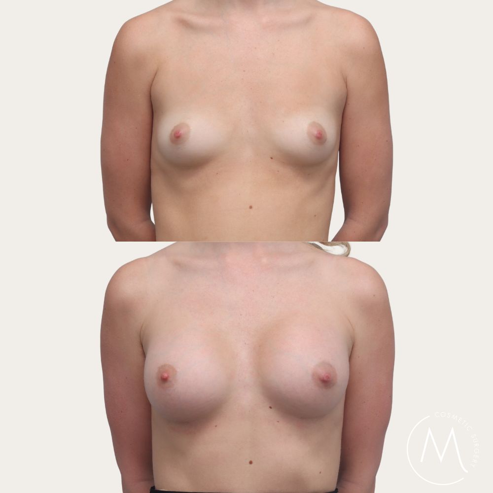 Before and after picture of breast augmentation patient