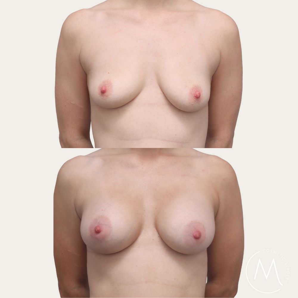 Before and after picture of breast augmentation patient