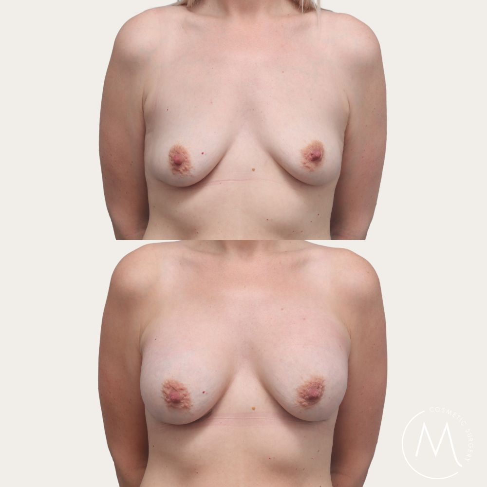 Before and after picture of breast revision patient