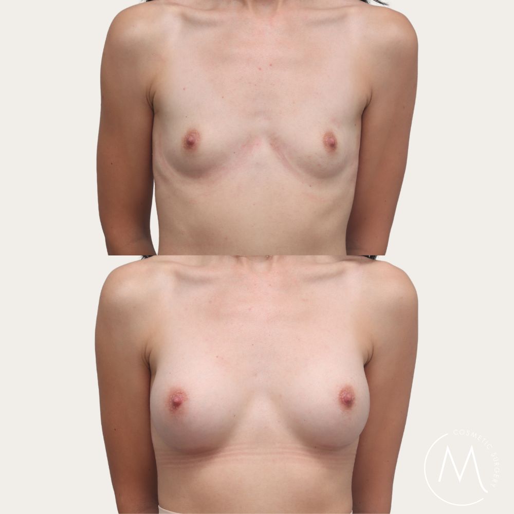 Before and after picture of breast augmentation patient