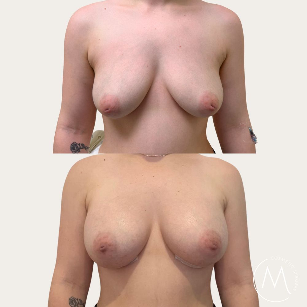 Before and after picture of breast augmentation patient