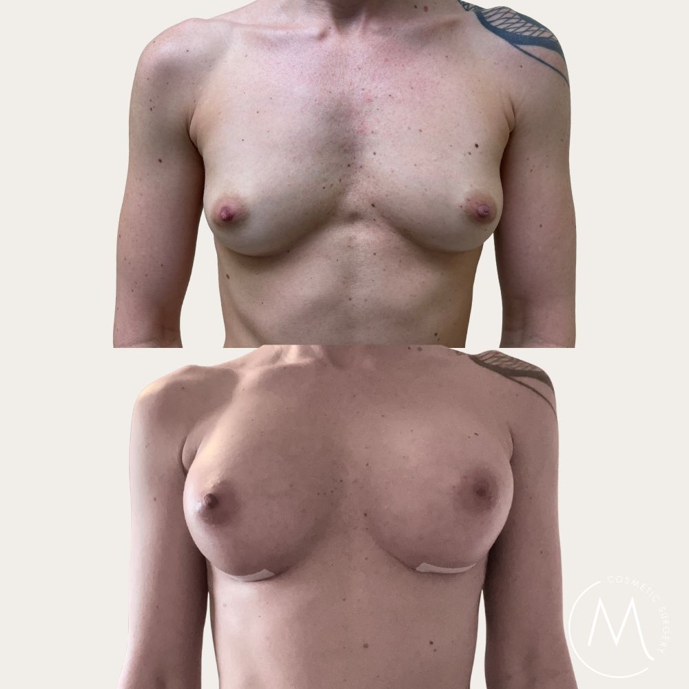Before and after picture of breast augmentation patient