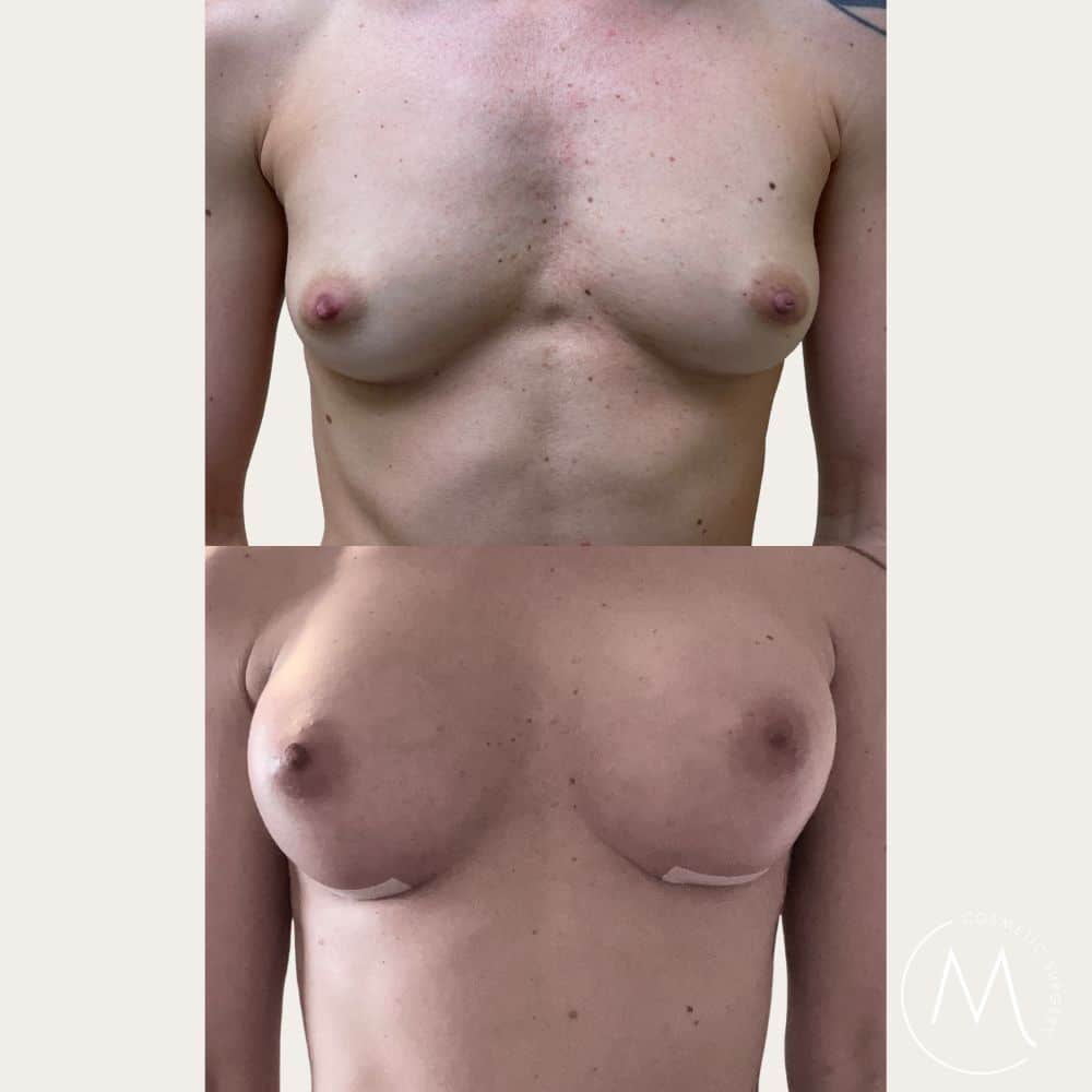 Before and after picture of breast augmentation patient