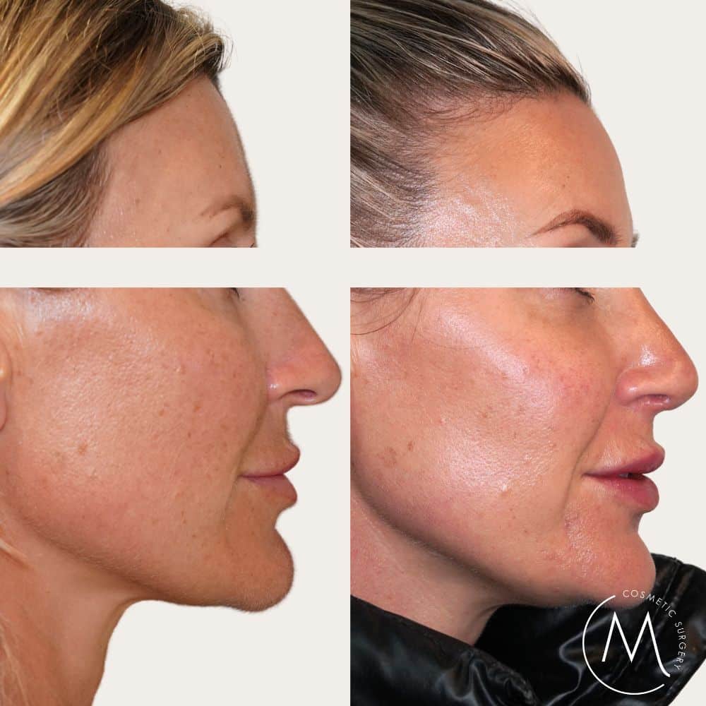 Before and after picture of rhinoplasty patient