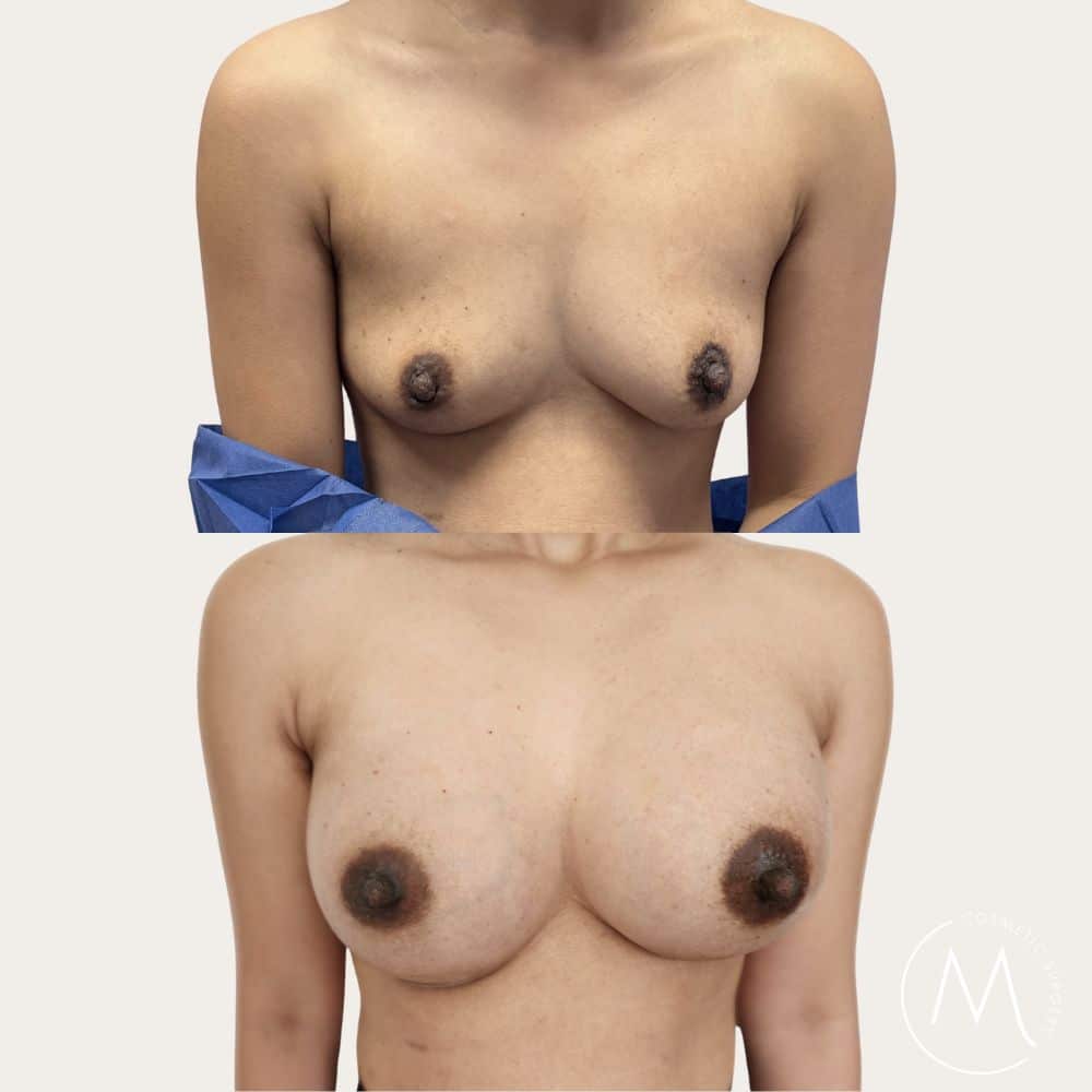 Before and after picture of breast augmentation patient
