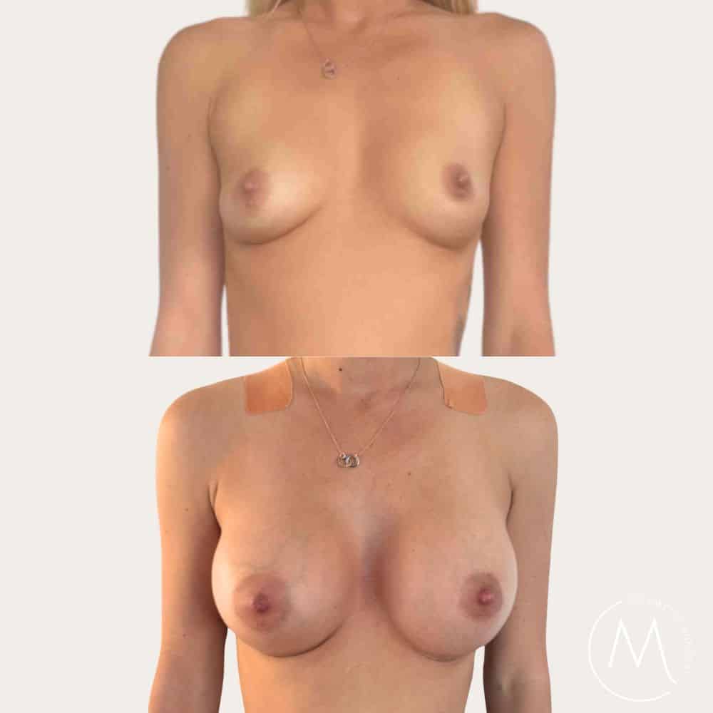 Before and after picture of breast augmentation patient