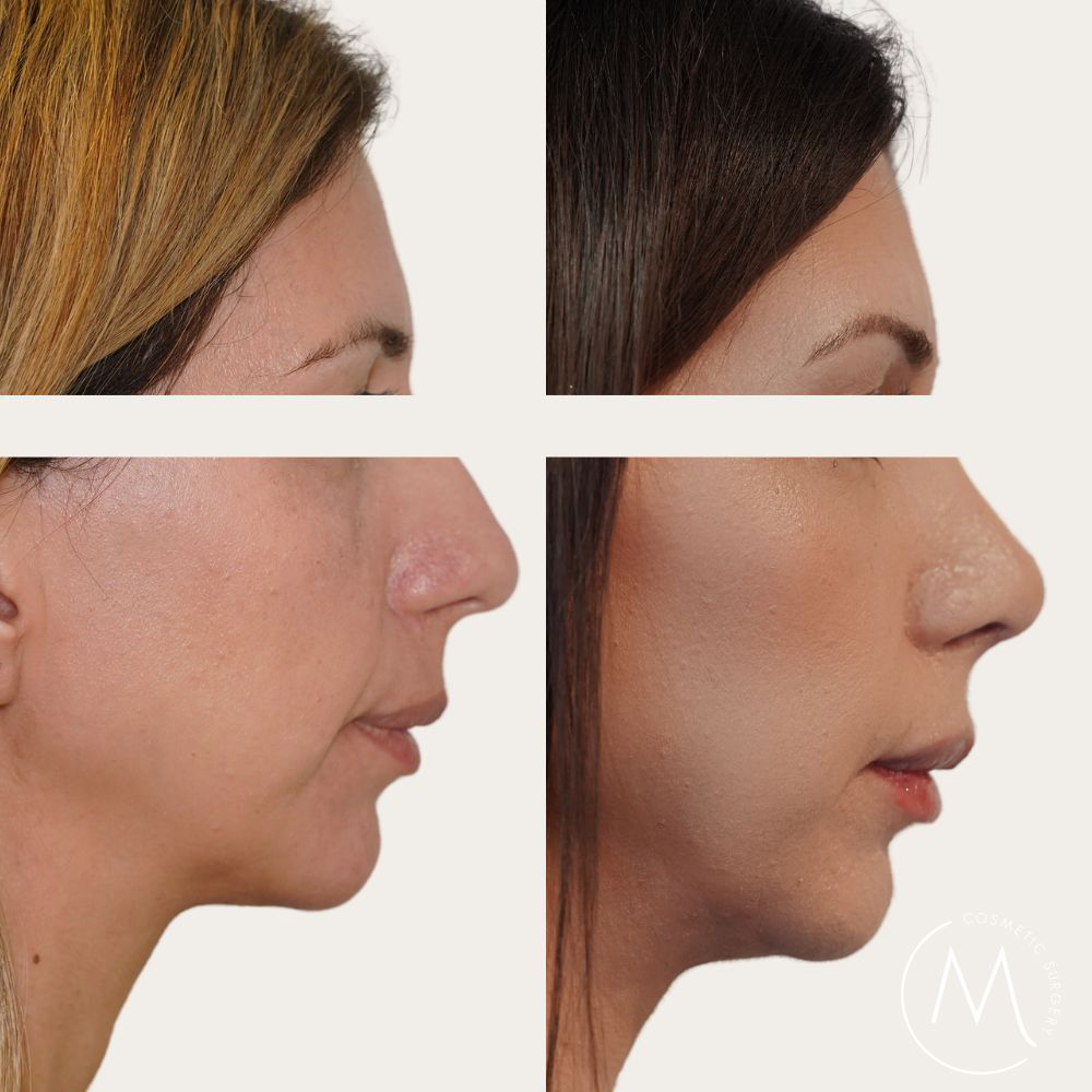 Before and after picture of rhinoplasty patient