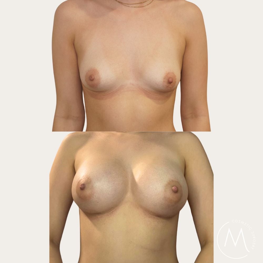 Before and after picture of breast augmentation patient