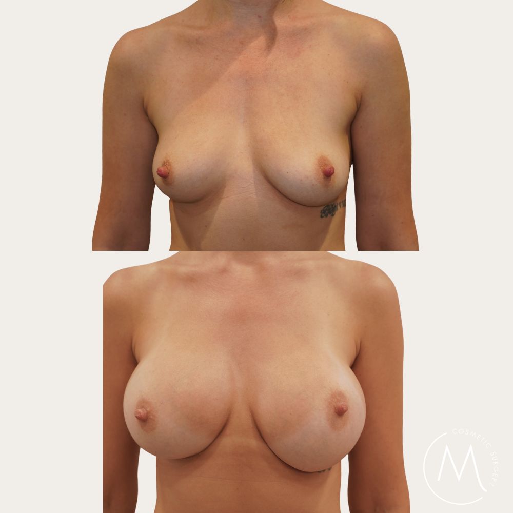 Before and after picture of breast augmentation patient