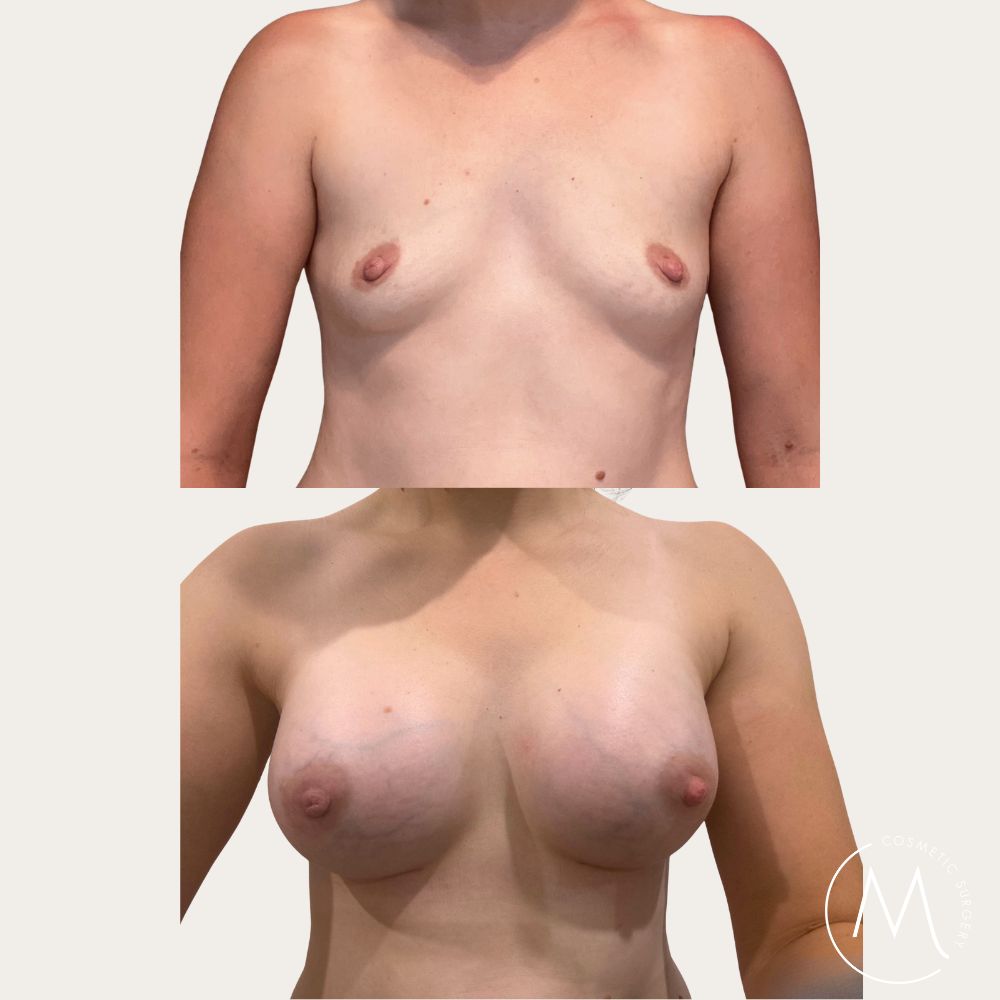 Before and after picture of breast augmentation patient