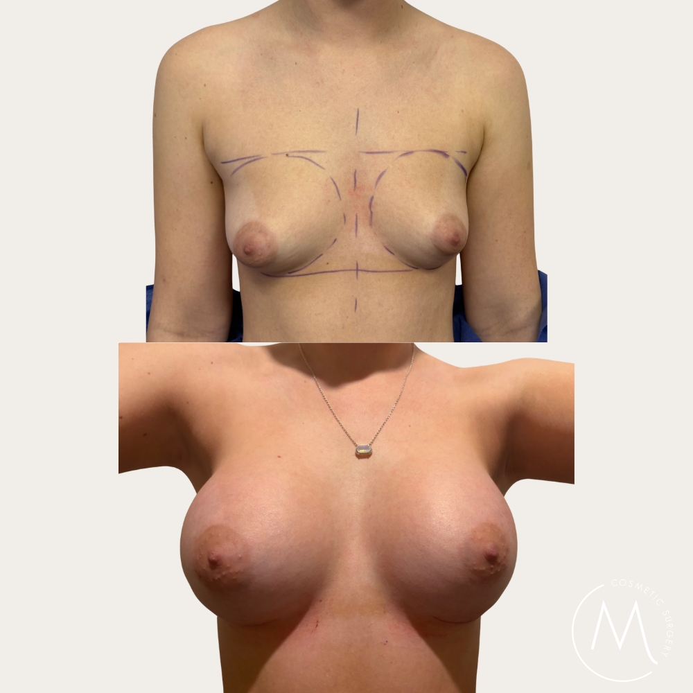 Before and after picture of breast augmentation patient