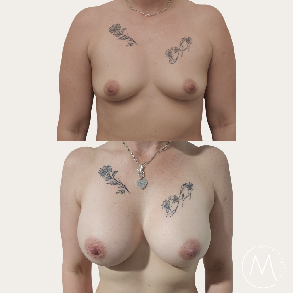 Before and after picture of breast augmentation patient