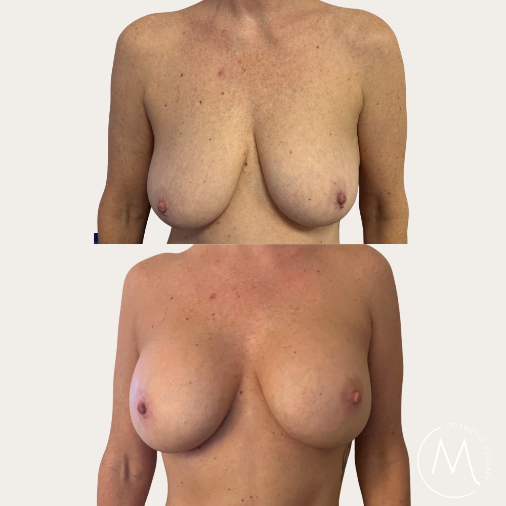 Before and after picture of breast augmentation patient