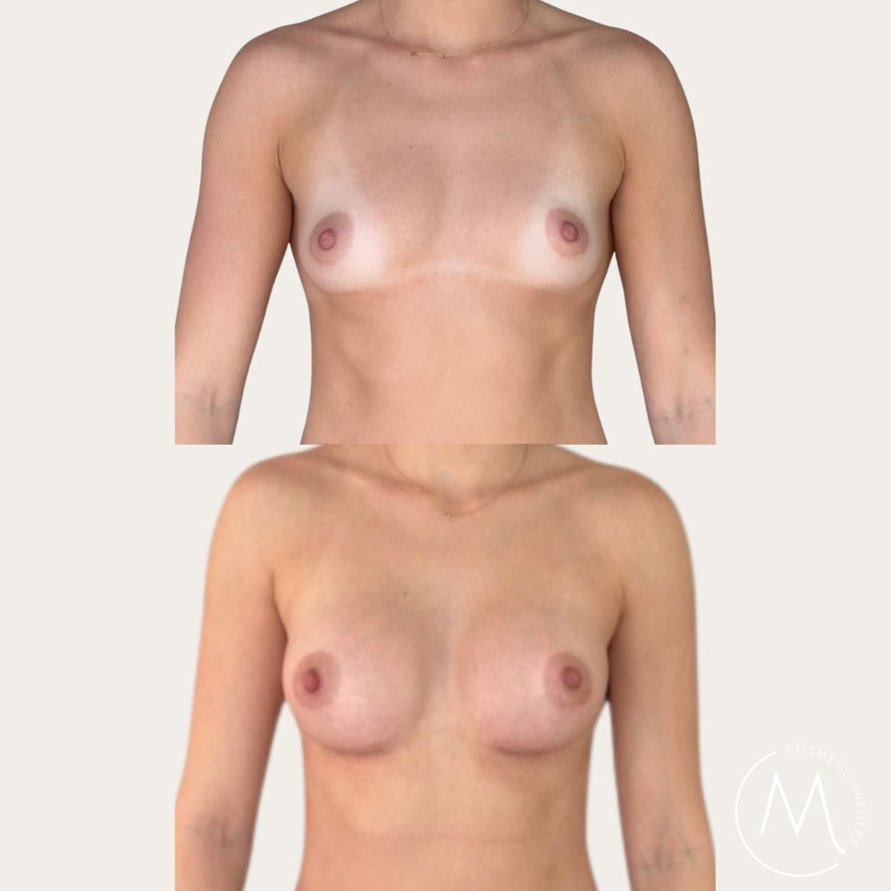Before and after picture of breast augmentation patient