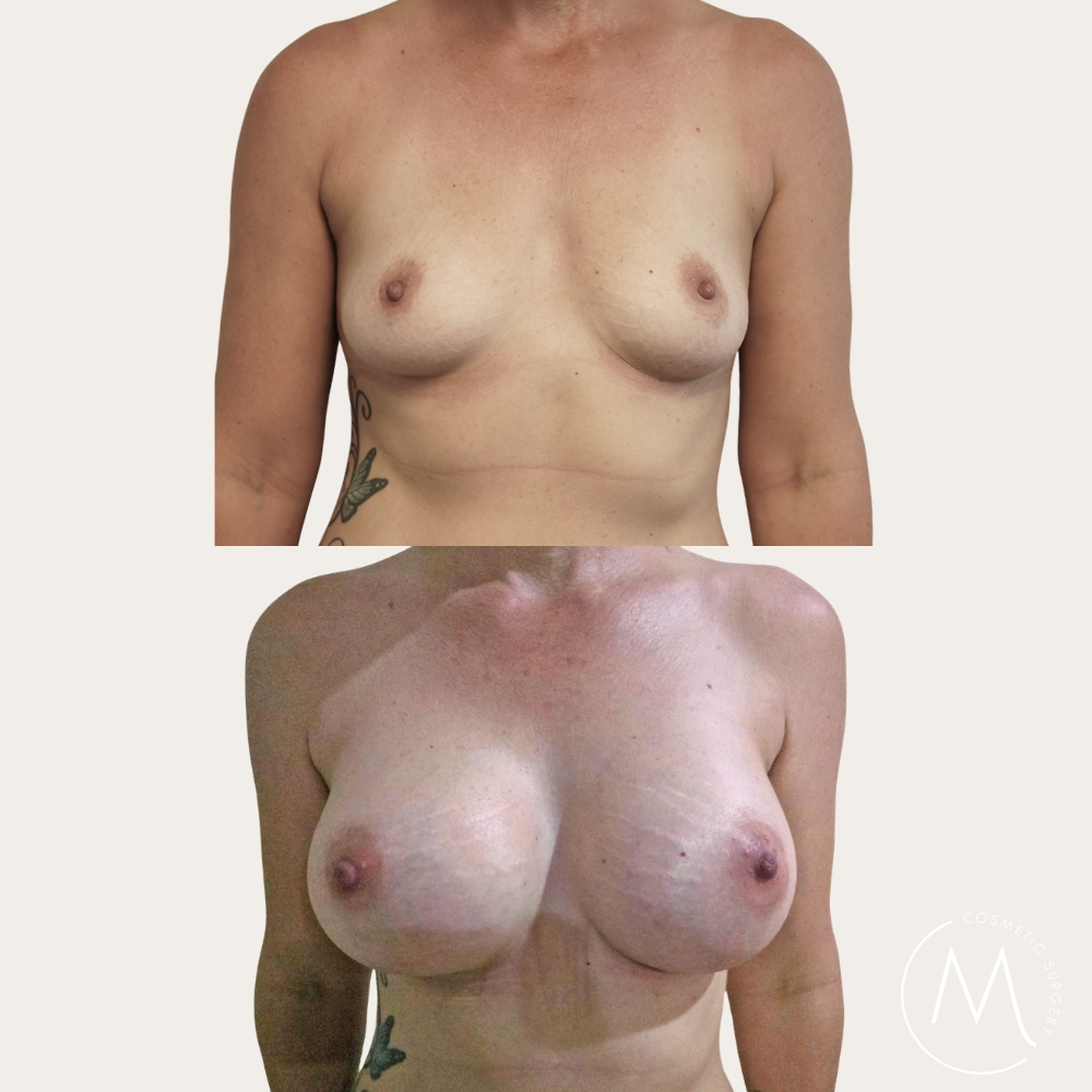 Before and after picture of breast augmentation patient